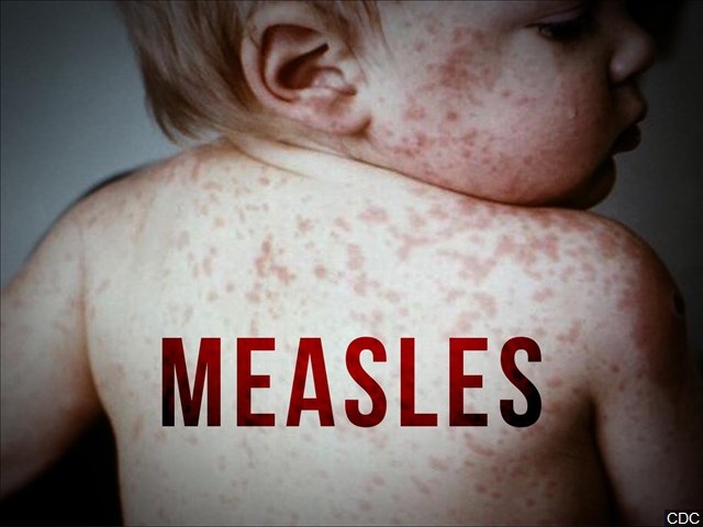 Measles