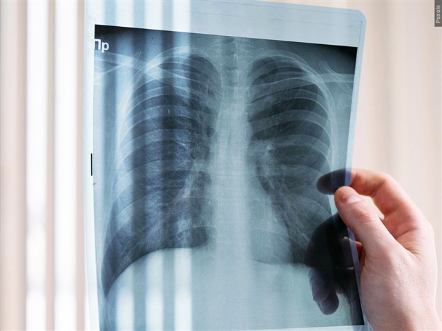 Generic Lung X-Ray